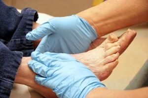Surgical Debridement  in Saving a Limb