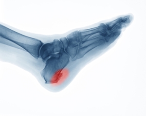 When Heel Pain Has a Hidden Cause