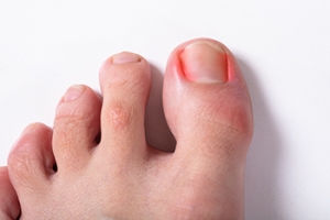 The Stages of Ingrown Toenails