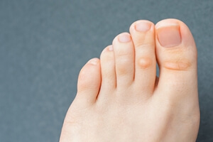 Runners With Corns