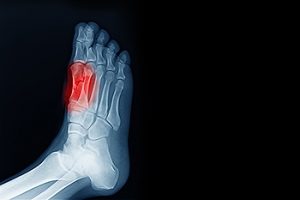 All About Sesamoiditis
